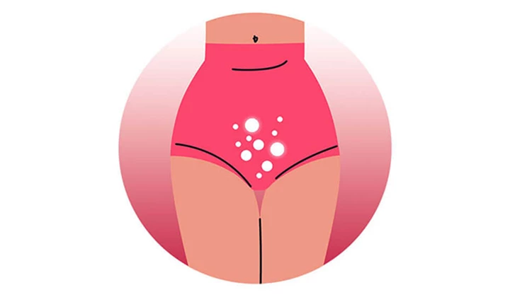 Abbildung der Milchsäurebakterien der Vaginalflora Abbildung der Milchsäurebakterien der Vaginalflora